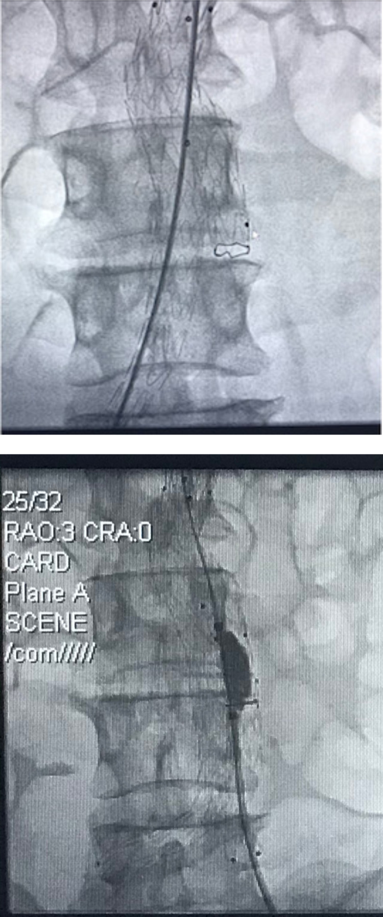 Endovascular repair of symptomatic abdominal aortic aneurysm: a seminal case in West Africa.