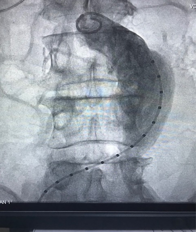 Endovascular repair of symptomatic abdominal aortic aneurysm: a seminal case in West Africa.