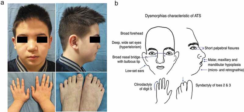 The clinical and genetic heterogeneity analysis of five families with primary periodic paralysis.