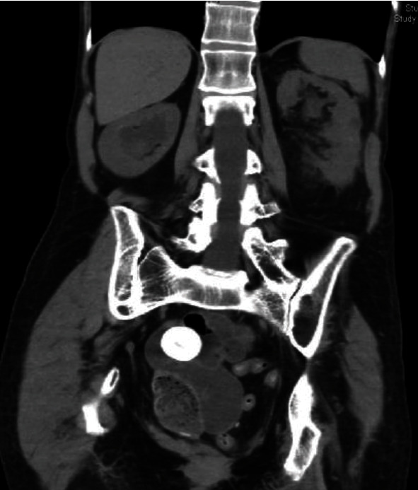 Minimally Invasive Robotic-Assisted Cystolithotomy in a Complicated Urinary Diversion: A Feasible and Safe Approach.