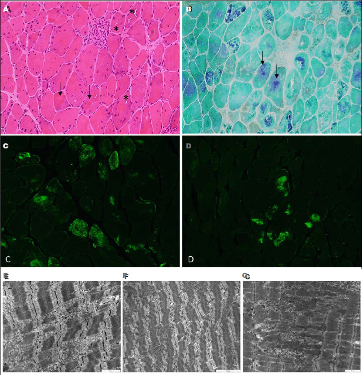 BAG3-related myofibrillar myopathy: a further observation with cardiomyopathy at onset in pediatric age.