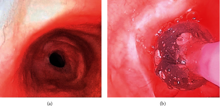 Airway Management and Anesthesia for Tracheal Resection in a 68-Year-Old: 3 Airways for the Price of 1.