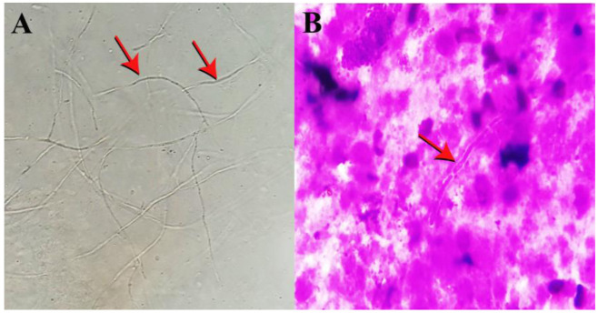 Fatal pulmonary <i>Scedosporium aurantiacum</i> infection in a patient after near-drowning: A case report.