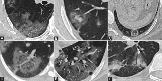 Predictive performance of CT for adverse outcomes among COVID-19 suspected patients: a two-center retrospective study.