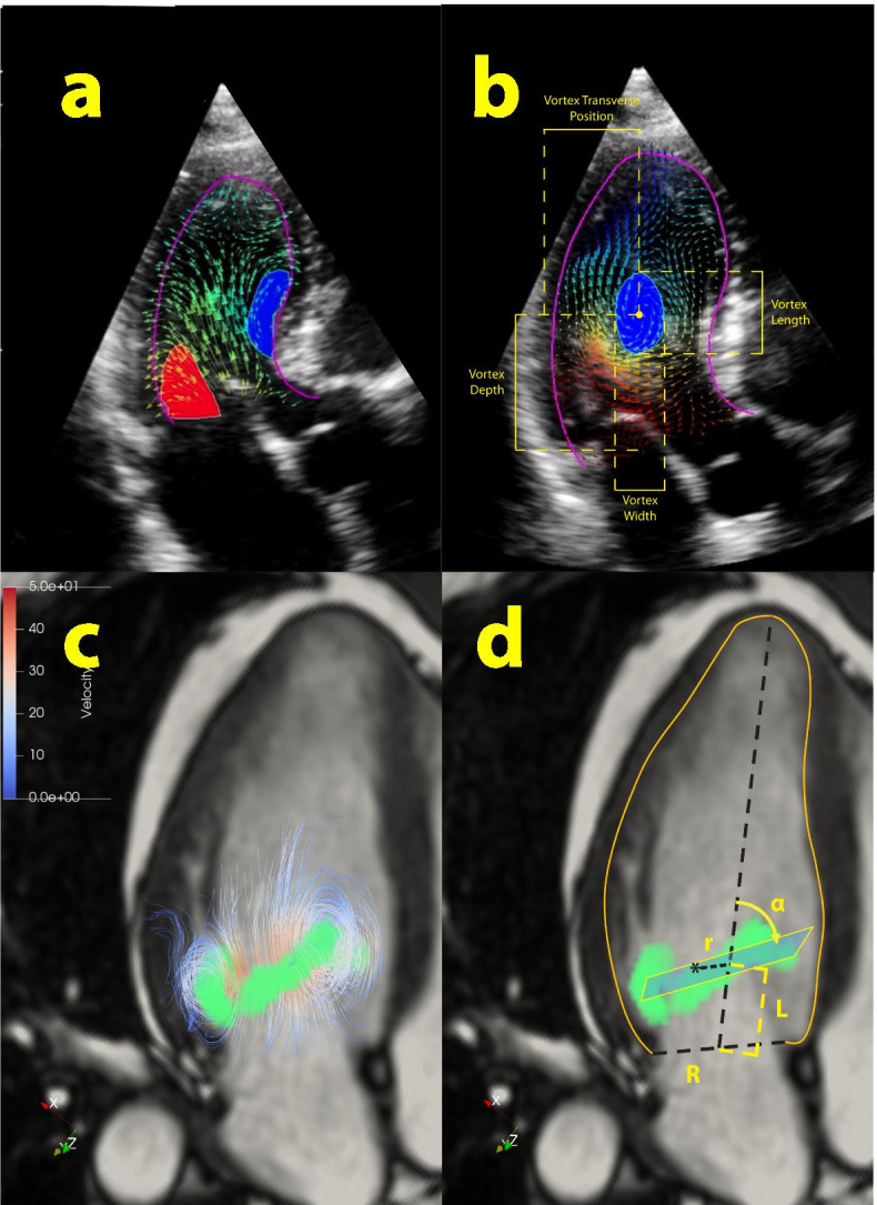 Evaluation of intraventricular flow by multimodality imaging: a review and meta-analysis.