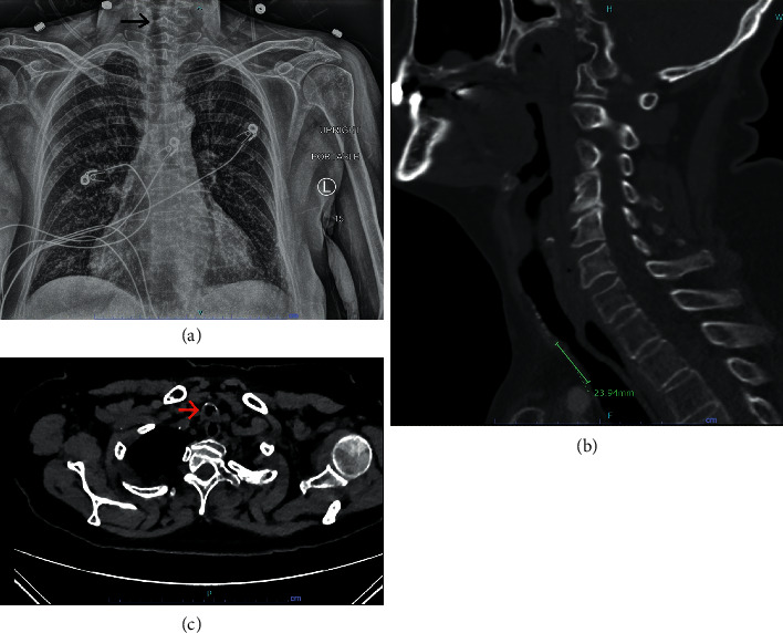 Airway Management and Anesthesia for Tracheal Resection in a 68-Year-Old: 3 Airways for the Price of 1.
