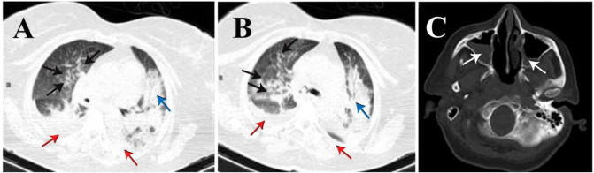 Fatal pulmonary <i>Scedosporium aurantiacum</i> infection in a patient after near-drowning: A case report.