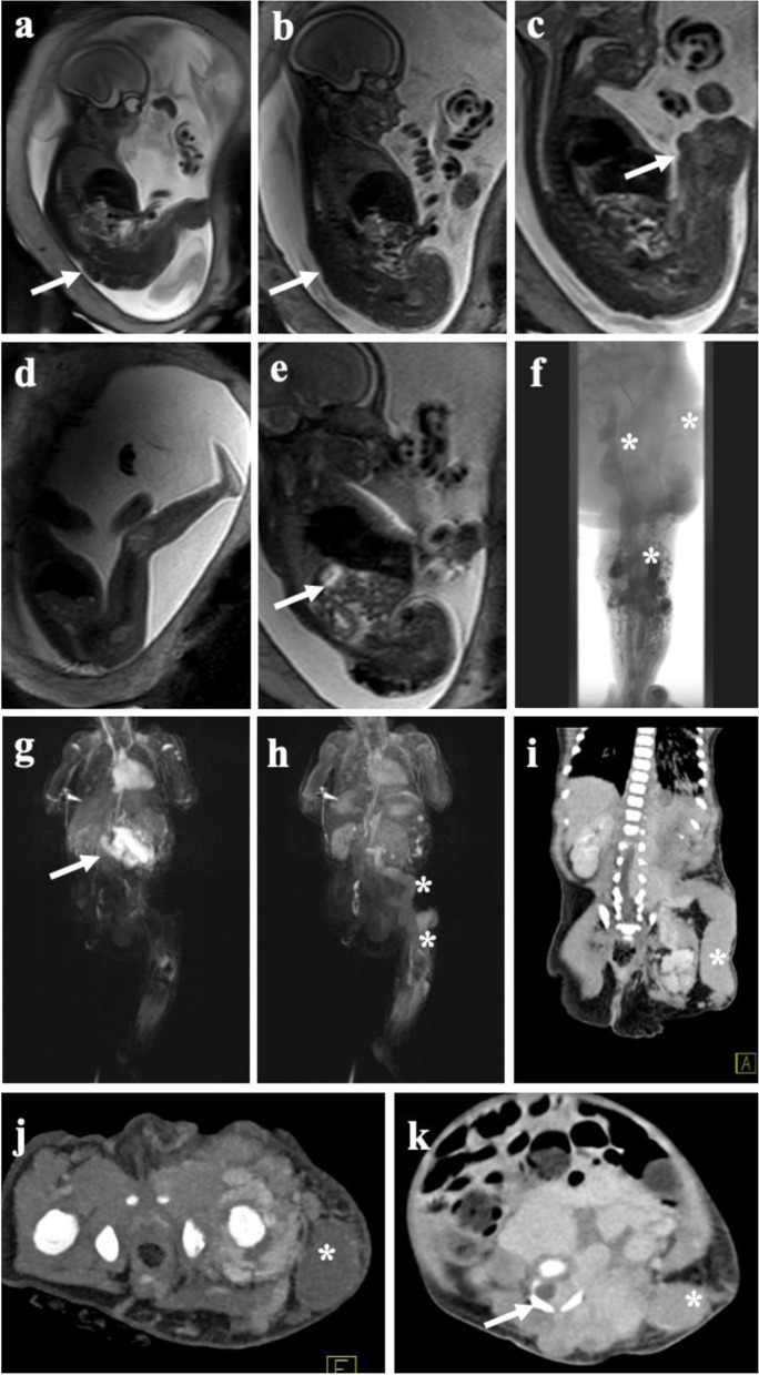 Imaging of peripheral vascular malformations - current concepts and future perspectives.