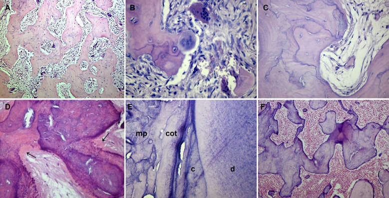 Paget's disease of the jaws: Histopathological features of a series of 31 cases.