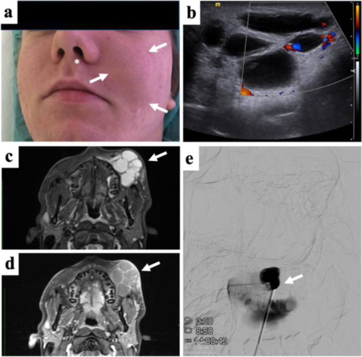 Imaging of peripheral vascular malformations - current concepts and future perspectives.