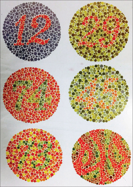 Prevalence of Color Vision Anomalies among Dental Professionals.