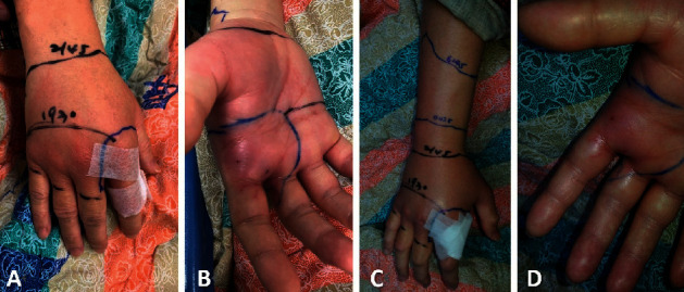 Personal Experience of <i>Daboia siamensis</i> Envenomation.