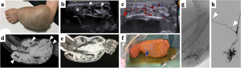 Imaging of peripheral vascular malformations - current concepts and future perspectives.