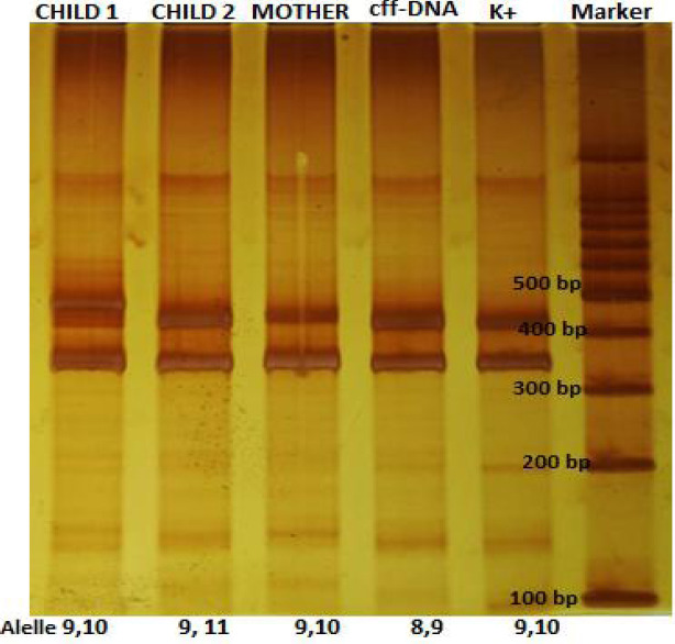 THE APPLICATION OF CELL-FREE FETAL DNA (cff-DNA) AND SIBLINGS DNA METHODS IN THE PROCESS OF PATERNITY TEST THROUGH CODIS STR LOCI (CSF1PO, THO1, TPOX, AND vWA).