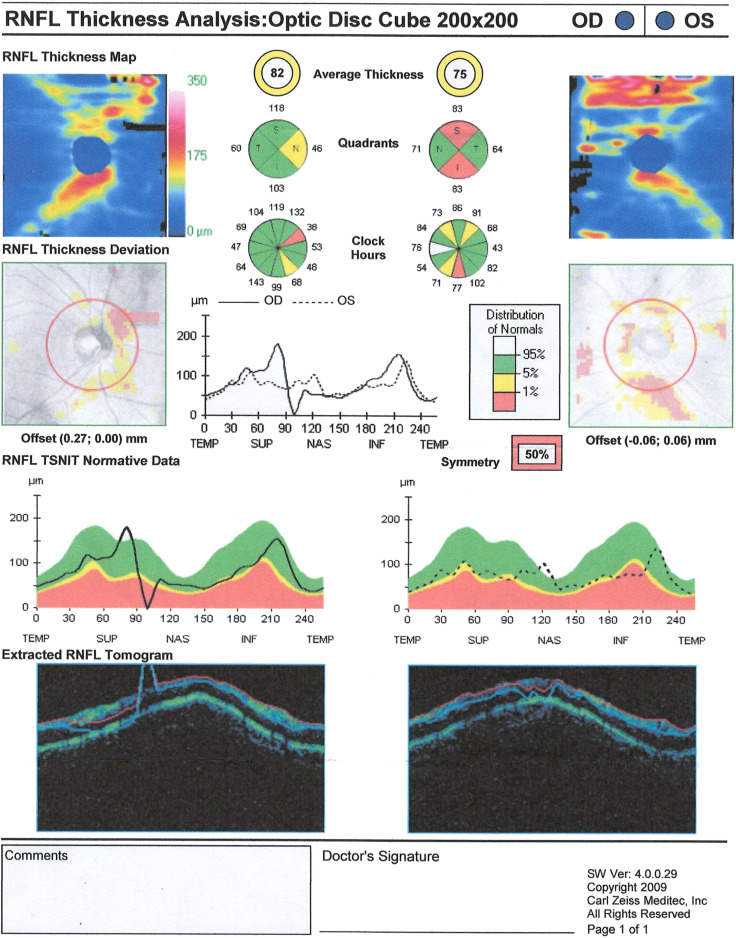 Optic Nerve Demyelination in IgG4 Anti-Neurofascin 155 Antibody-Positive Combined Central and Peripheral Demyelination Syndrome.