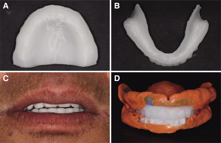 Evaluation of functional suitable digital complete denture system based on 3D printing technology.