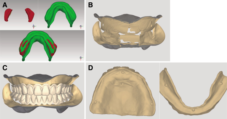 Evaluation of functional suitable digital complete denture system based on 3D printing technology.