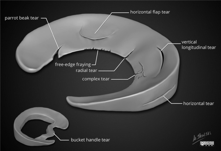 A review of strategies for development of tissue engineered meniscal implants