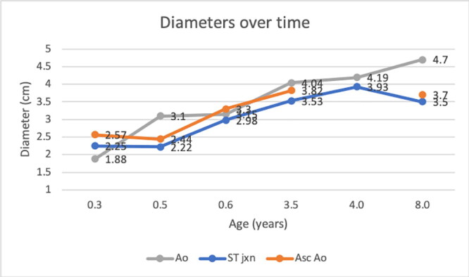 Annuloaortic ectasia in a four-month-old male Newfoundland dog: long-term follow-up and immunofluorescent study.