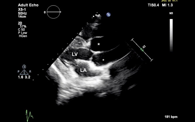 Annuloaortic ectasia in a four-month-old male Newfoundland dog: long-term follow-up and immunofluorescent study.