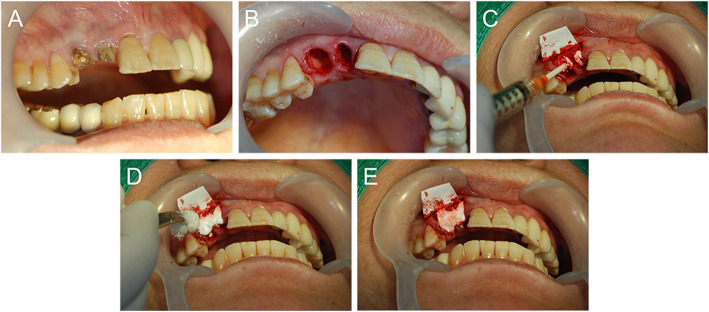 Efficacy and safety of rhBMP/β-TCP in alveolar ridge preservation: a multicenter, randomized, open-label, comparative, investigator-blinded clinical trial.