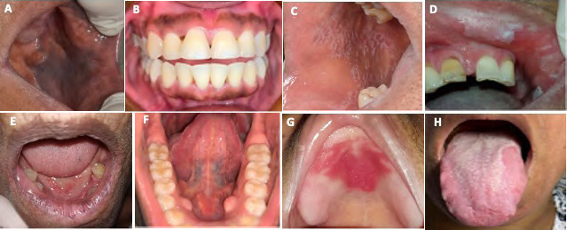 Prevalence of oral mucosal lesions in an adult population from eight communities in Santo Domingo, Dominican Republic.