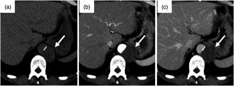 A case of primary aortic sarcoma with tumor infarction after stent graft placement.