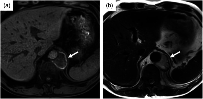 A case of primary aortic sarcoma with tumor infarction after stent graft placement.