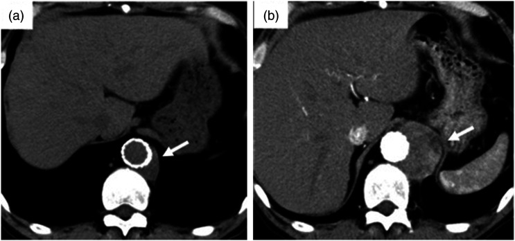 A case of primary aortic sarcoma with tumor infarction after stent graft placement.