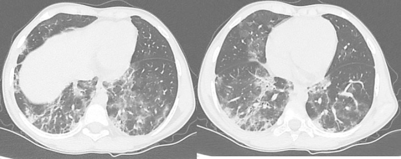 Severe Acute Respiratory Syndrome Corona Virus-2 Infection in a Pediatric Kidney Transplant Recipient: A Case Report from India.