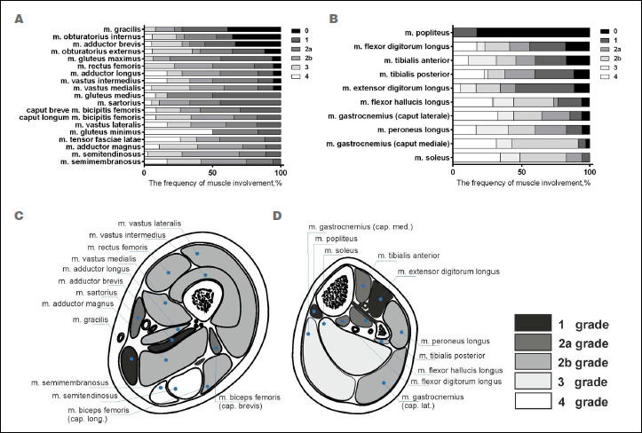 Magnetic resonance imaging pattern variability in dysferlinopathy.