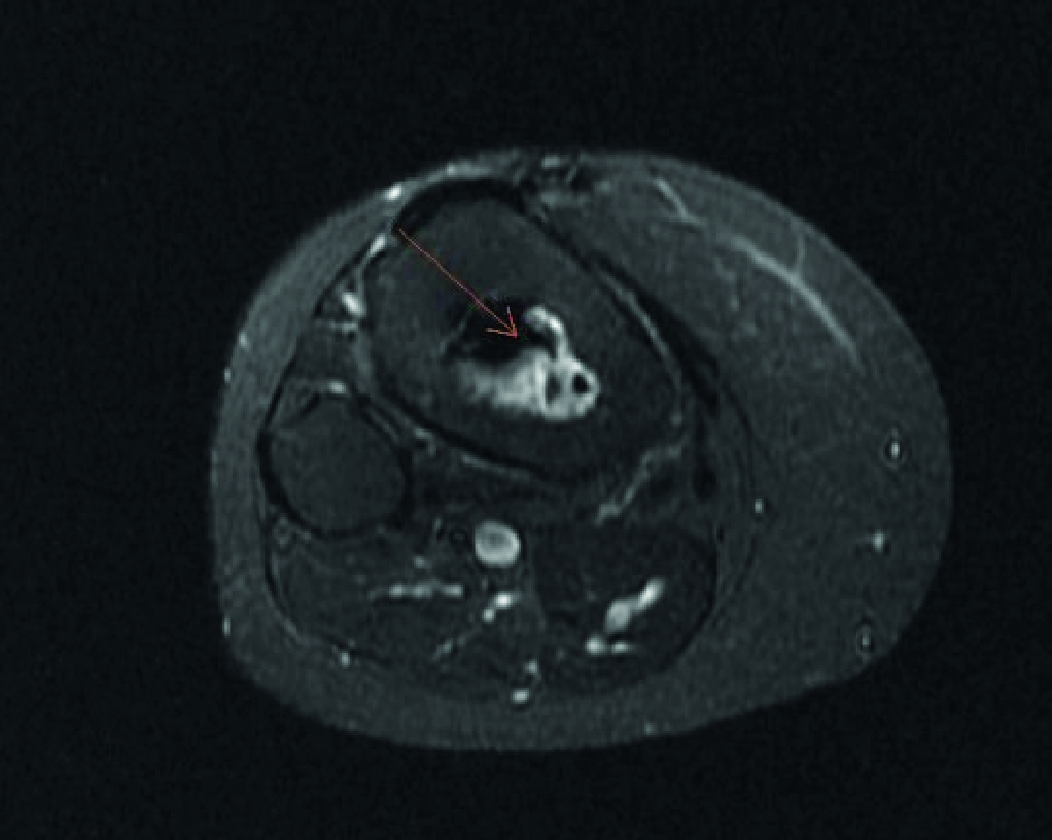 Multi-joint steroid-induced avascular necrosis in a malignant brain tumor patient.