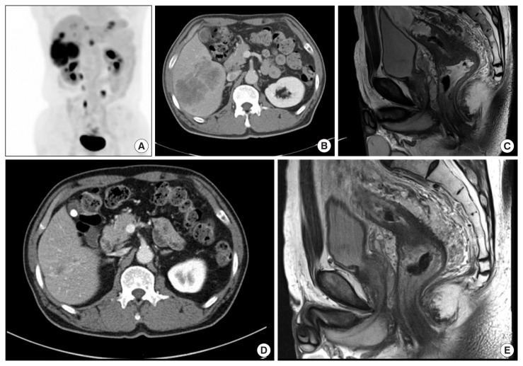 Short-course radiotherapy and chemotherapy for conversion surgery in patients with unresectable metastatic rectal cancer: a preliminary case series study.