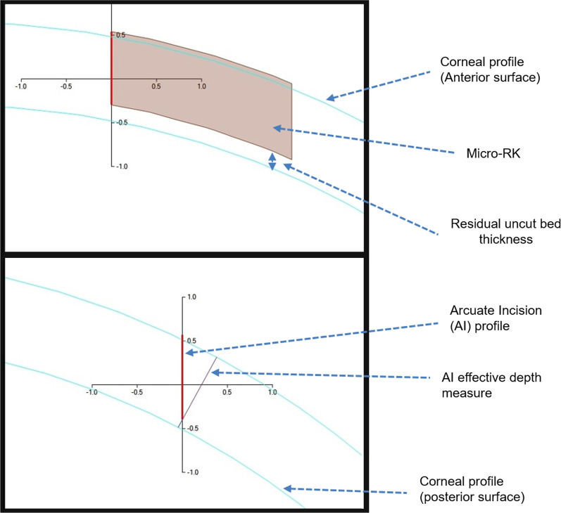 Accuracy and safety of partial thickness femtosecond laser radial and arcuate keratotomy incisions in porcine eyes.