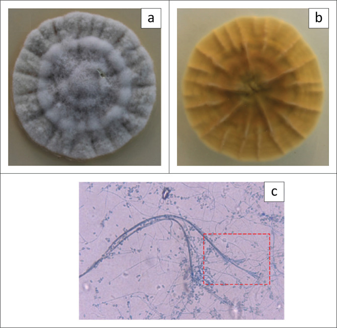 Exogenous fungal endophthalmitis in a potato farm worker.