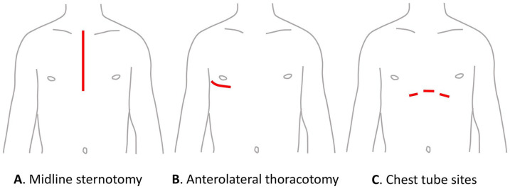 Persistent Pain After Cardiac Surgery: Prevention and Management.