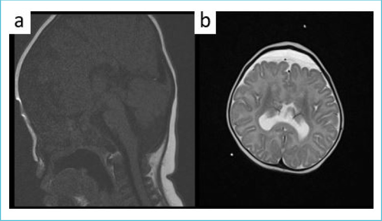 Asymptomatic Hypernatremia in an Infant with Midline Defects.