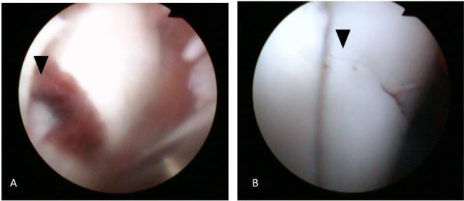 Arthroscopic guided repair of a slab fracture of the fourth carpal bone in an 8-month-old thoroughbred horse.