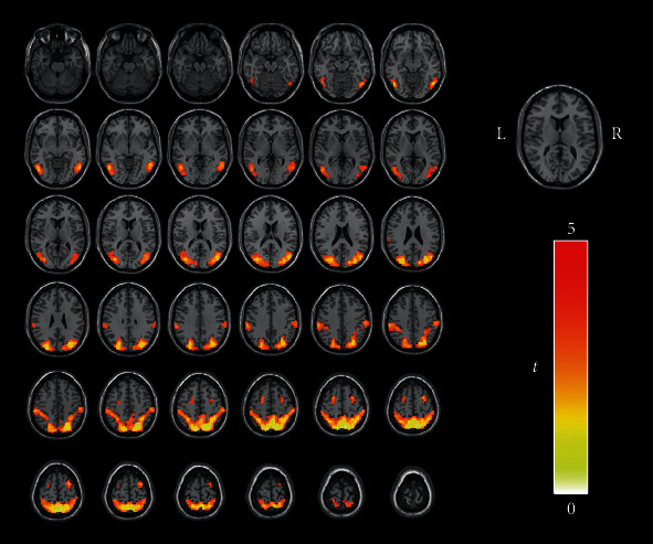 Aberrant Resting-State Functional Connectivity of the Dorsal Attention Network in Tinnitus.