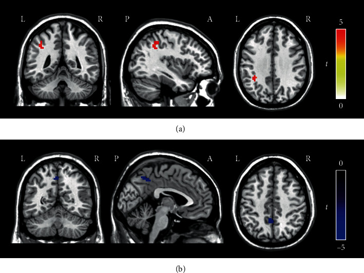 Aberrant Resting-State Functional Connectivity of the Dorsal Attention Network in Tinnitus.