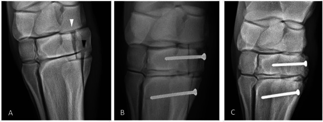 Arthroscopic guided repair of a slab fracture of the fourth carpal bone in an 8-month-old thoroughbred horse.