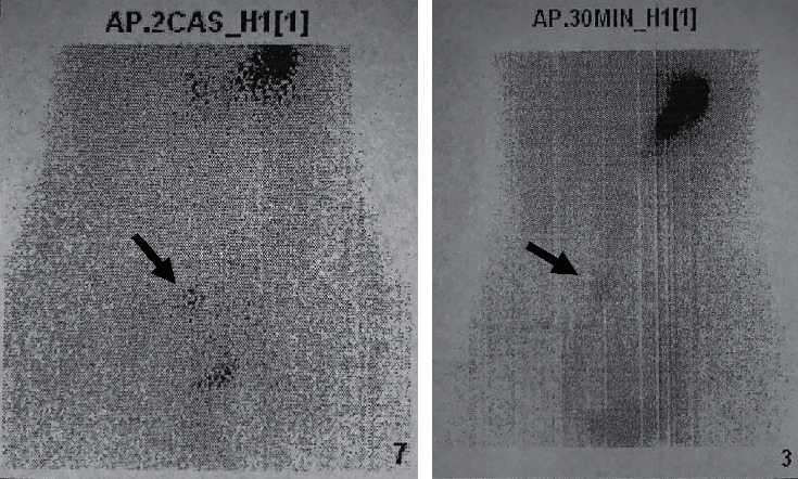 Bleeding Meckel's Diverticulum in a 33-Year-Old Female Diagnosed with Video Capsule Endoscopy and a Technetium-99 m Pertechnetate Scan with a Favorable Response to H<sub>2</sub> Blocker and PPI.