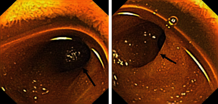 Bleeding Meckel's Diverticulum in a 33-Year-Old Female Diagnosed with Video Capsule Endoscopy and a Technetium-99 m Pertechnetate Scan with a Favorable Response to H<sub>2</sub> Blocker and PPI.