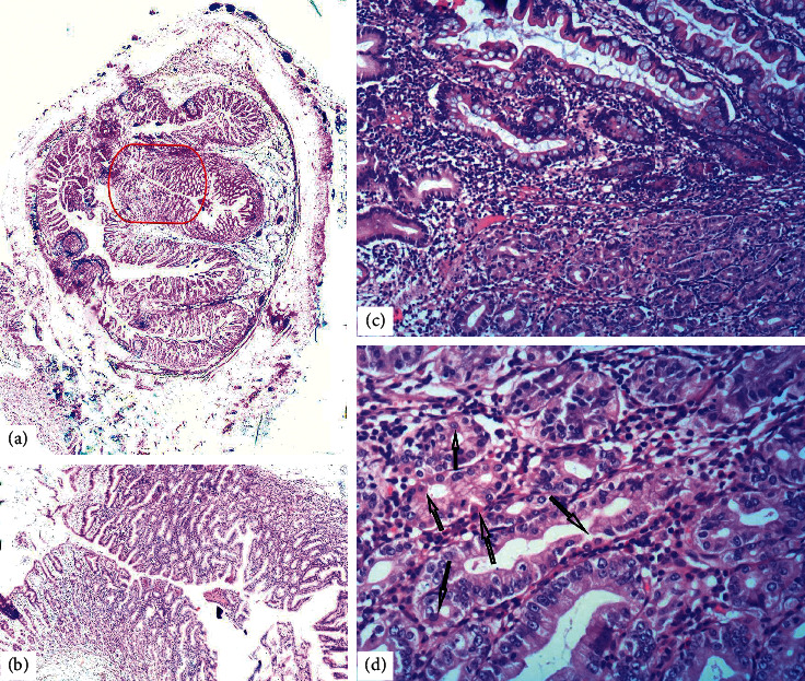 Bleeding Meckel's Diverticulum in a 33-Year-Old Female Diagnosed with Video Capsule Endoscopy and a Technetium-99 m Pertechnetate Scan with a Favorable Response to H<sub>2</sub> Blocker and PPI.