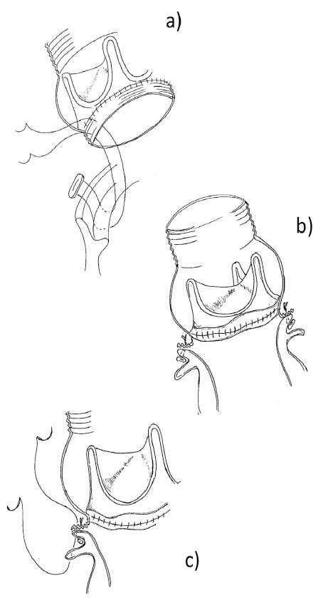 Long-term results of modified bentall procedures: 18-year experience of the flanged technique.