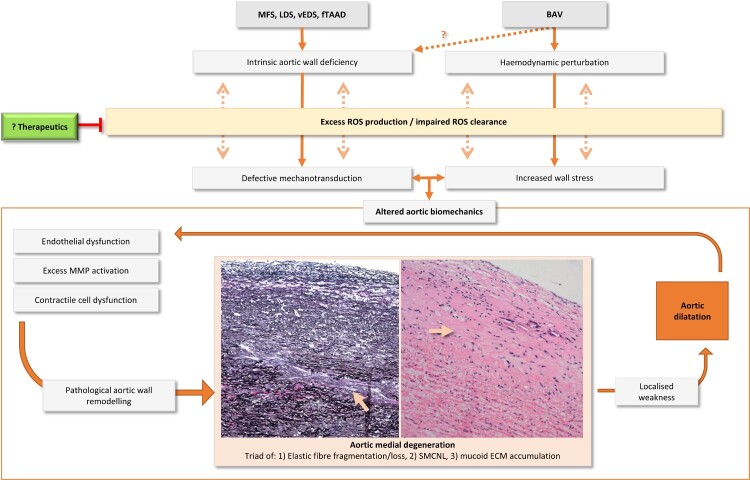 Oxidative stress in genetically triggered thoracic aortic aneurysm: role in pathogenesis and therapeutic opportunities.