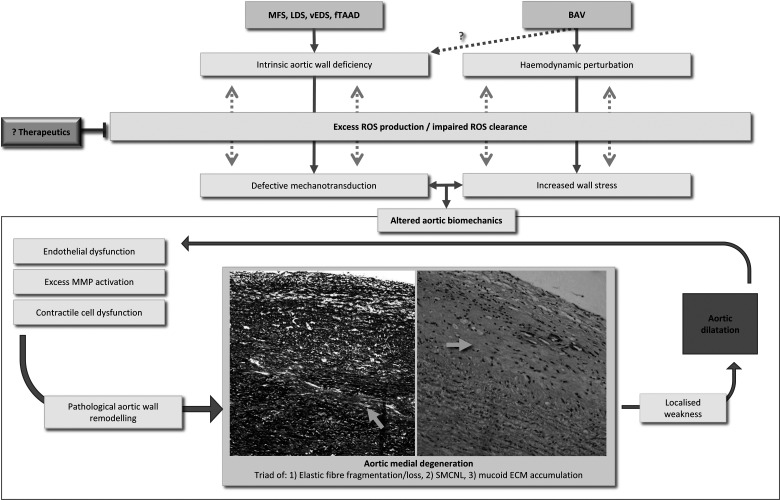 Oxidative stress in genetically triggered thoracic aortic aneurysm: role in pathogenesis and therapeutic opportunities.