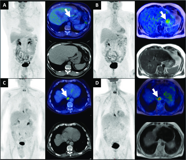 Initial experience in staging primary oesophageal/gastro-oesophageal cancer with 18F-FDG PET/MRI.