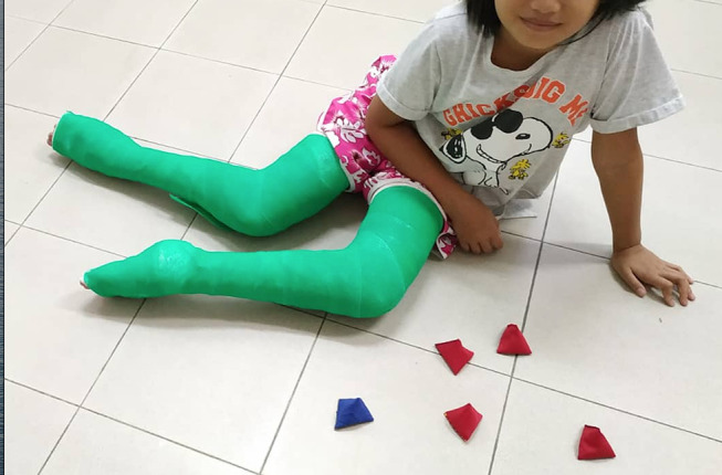 Modified Ponseti Technique in an Eleven-Year-Old with Bilateral Untreated Clubfoot: A Case Report.