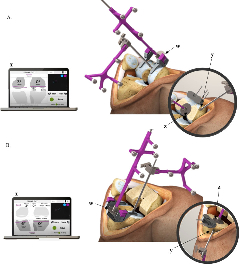 The use of imageless navigation to quantify cutting error in total knee arthroplasty.